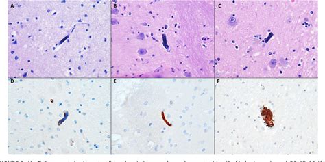 Figure From Entrapped Megakaryocytes In The Microvasculature Of Brain