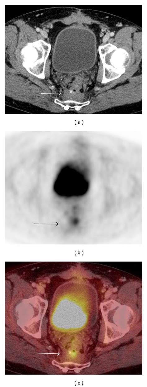 Local Recurrence Years Following Resection Of Rectal Carcinoma A