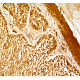 Maspin Immunoreactivity In Periocular Basal Cell Carcinoma