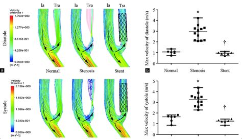 Velocity Of Normal Stenotic And Stented Transplant Renal Artery A