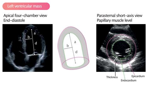 Masse Et Volume Du Ventricule Gauche Taille M Decine Cardiovasculaire