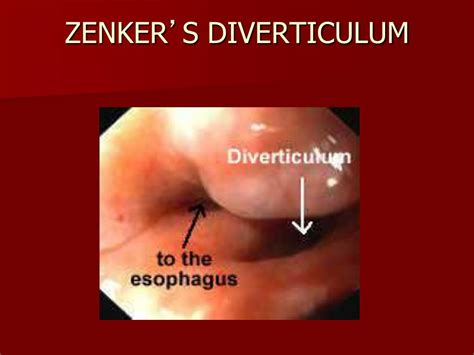 Ppt Esophageal Topics Powerpoint Presentation Free Download Id 5641383