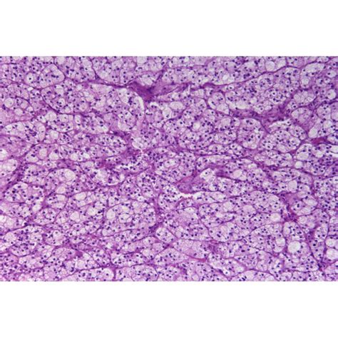 Adrenal Cortical Adenoma Sec Medical And Science Media