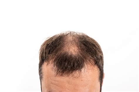 Top Myths And Truths About Hair Loss And Treatments Capilclinic