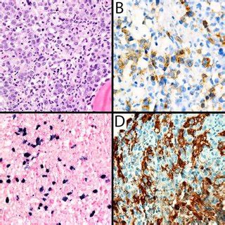 Bone Marrow Biopsy From A Patient Diagnosed With Systemic Ebv Positive