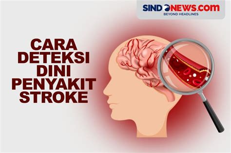 Sindografis Jadi Penyakit Mematikan Begini Cara Deteksi Dini Stroke