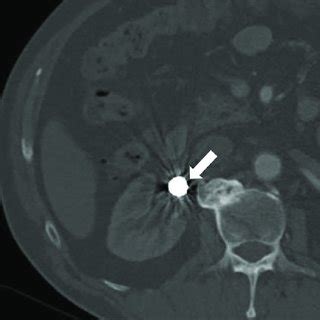 Follow Up Contrast Enhanced Computed Tomography 1 Month After The