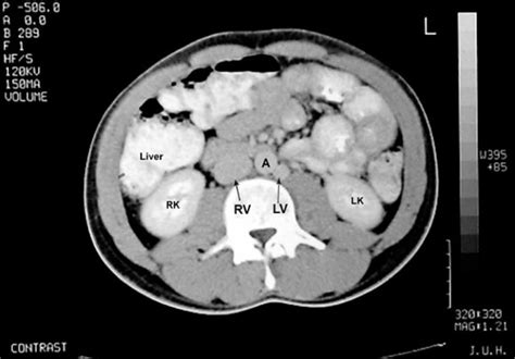 Doble Vena Cava Inferior Detectada A Trav S De Venograf A Por