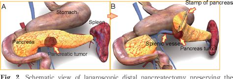 Figure 2 From Laparoscopic Distal Pancreatectomy Preserving The Spleen And Splenic Vessels For