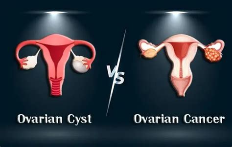 Ovarian Cysts Vs Cancer Understanding The Differences