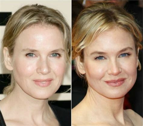 What Experts And Others Have To Say About Renee Zellweger Plastic Surgery