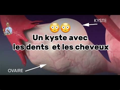 Kystes Ovariens Ce Que Chaque Femme Devrait Savoir Youtube