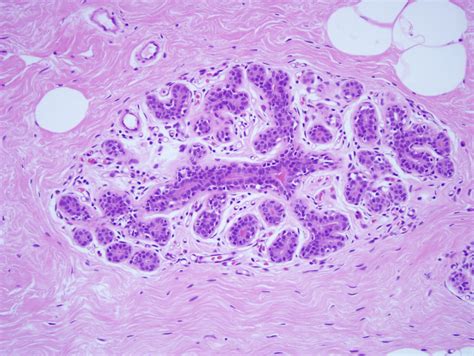 Breast Ductal Carcinoma In Situ Article