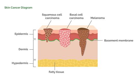 Melanoma Skin Cancer Diagram