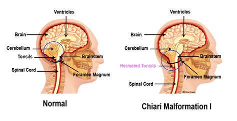 What Is Chiari The Chiari Project