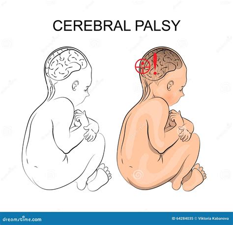 Cerebral Palsy And Hardship In Life - Pictured By Word Cerebral Palsy As A Heavy Weight On ...