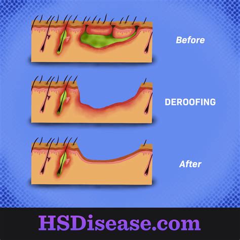 Hidradenitis Suppurativa Surgery Groin