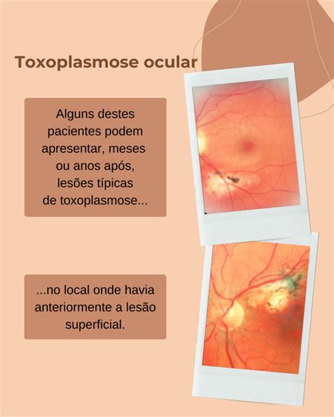 Toxoplasmose Ocular Sinais Superficiais Cl Nica Silveira