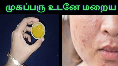 How To Remove Pimples From Face In Tamil முகப்பரு நீங்க Mugaparu Tips In Tamil Youtube