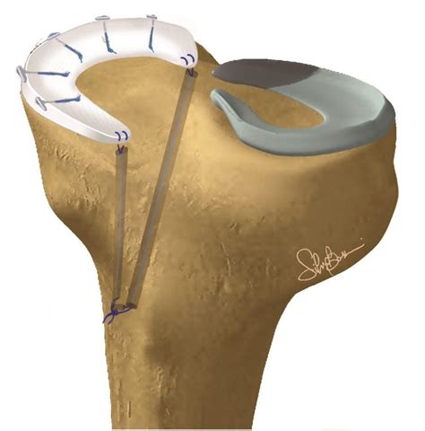 Meniscus Transplantation Marcheggiani Muccioli