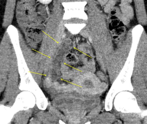 Acute Appendicitis Radiology Case Collection