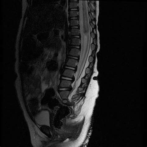 Caudal Regression Syndrome Wikidoc