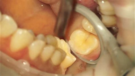 Maxillary Second Molar Crown Preparation Under Dental Microscope Youtube