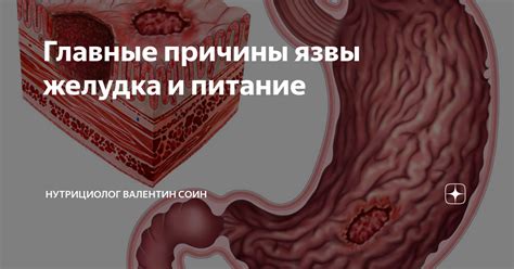 Главные причины язвы желудка и питание | Валентин Соин "Древо Жизни" | Дзен