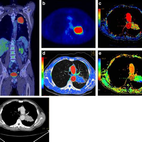 A 68 Year Old Man With A Squamous Cell Carcinoma In The Upper Lobe Of