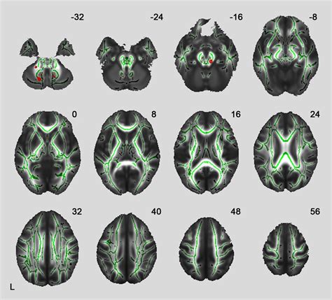 Sex Dimorphism In The White Matter Fractional Anisotropy And Brain Size Takao 2014