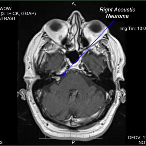 Acoustic Neuroma Atlantic Ent Llcatlantic Ent Llc