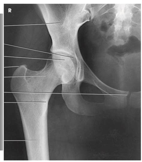 Diagram X Ray Of AP Hip Diagram Quizlet