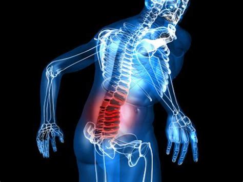 Lumbar Radicular Symptoms