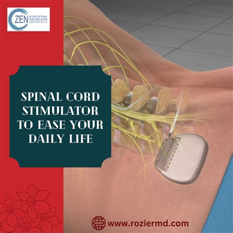 Spinal Cord Stimulator To Ease Your Daily Life In Mansfield Tx