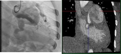 A CASE OF GIANT LEFT MAIN CORONARY ARTERY ANEURYSM Journal Of The