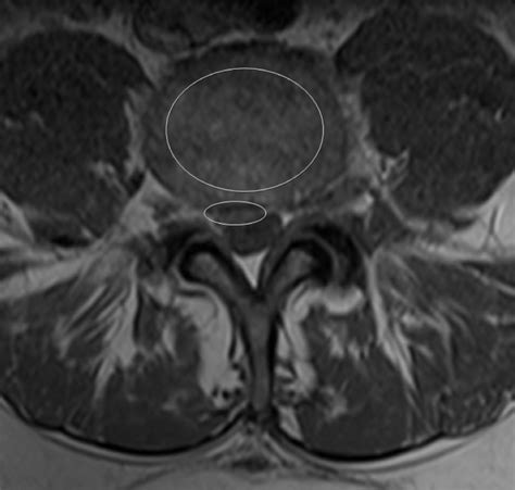 Healthcare Extreme How To Read An Mri Lumbar Spine In Easy 58 Off