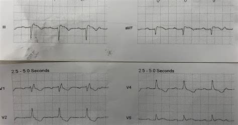 Dr. Smith's ECG Blog: RBBB and inverted hyperacute T-wave in V3. Do not ...