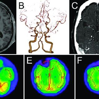 A Contrast Enhanced T Weighted Magnetic Resonance Imaging Shows No