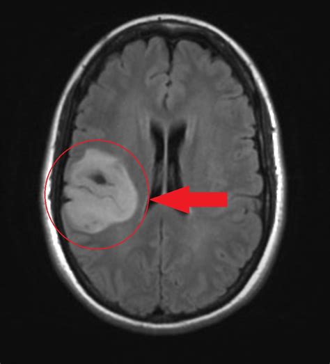 Small Astrocytoma Mri