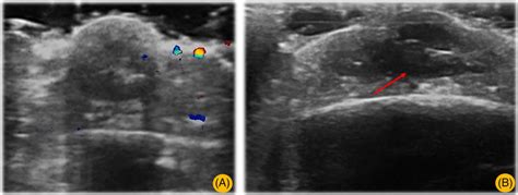 A, US (18 MHz): Multiple oval‐shaped anechoic lesions in the ...