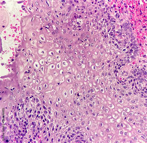 Cervix displays HPV (human papilloma virus) cytopathic effect, magnification 400x, photo under ...