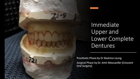 Immediate Dentures Steps