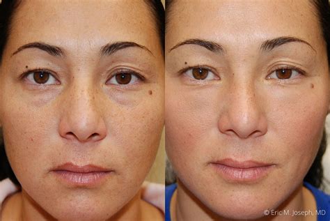 Eric M Joseph Md Botox® And Xeomin® Before And After Photos