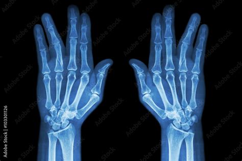 Fracture Shaft Of Proximal Phalange Of Ring Finger Film X Ray Both