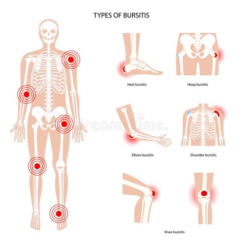 Conjunto De Iconos De Bursitis Ilustración del Vector Ilustración de