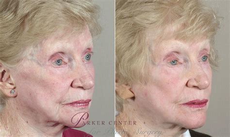 Facelift Before And After Pictures Case 35 Paramus New Jersey Parker Center For Plastic Surgery