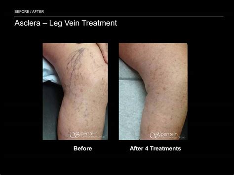 Before After Photos Of Asclera Vein Reduction Treatment Results