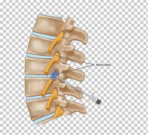 Nerve Root Injection Vertebral Column Nerve Block PNG, Clipart, Ache ...