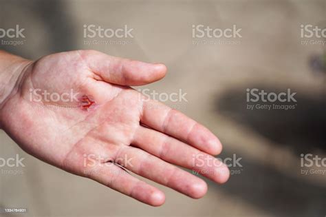 Torn Callus Of The Hand Closeup Rough Skin Of Male Hand Stock Photo