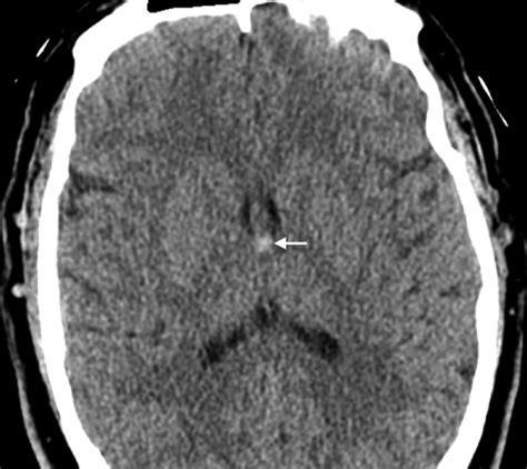 16 Colloid Cyst Radiology Key